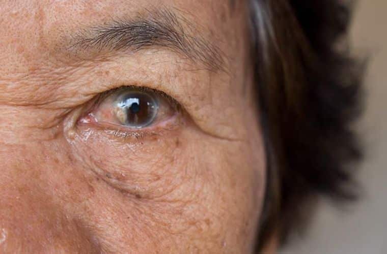 khám mắt cho người cao tuổi