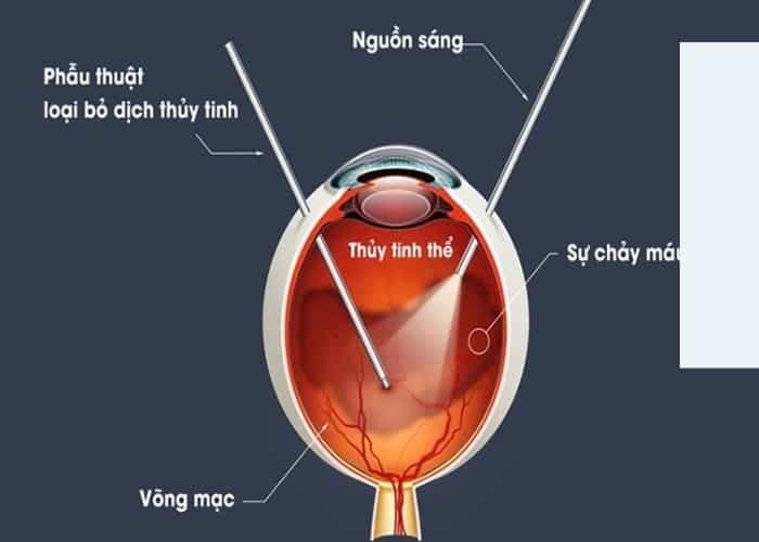 Dịch kính võng mạc 3