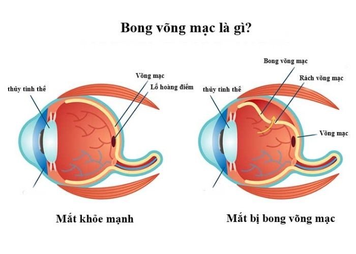 Dịch kính võng mạc 4