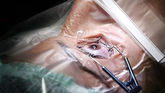 điều trị dứt điểm tình trạng mắt lác hiệu quả cao