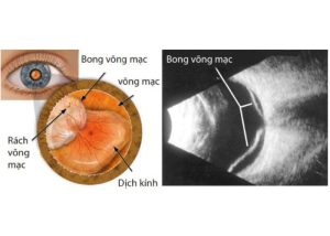 Laser quang đông võng mạc 7