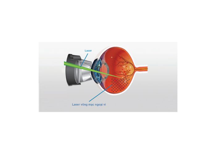 Quy trình Laser quang đông võng mạc diễn ra như thế nào?