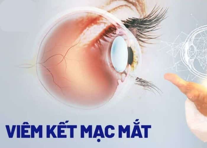 Bệnh viêm kết mạc 5