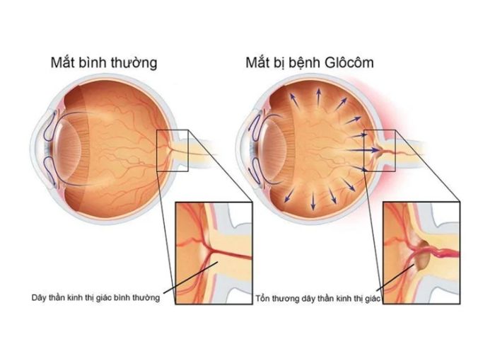 khu vực hốc mắt bị đau cảnh báo mắt đang bịu tổn thương