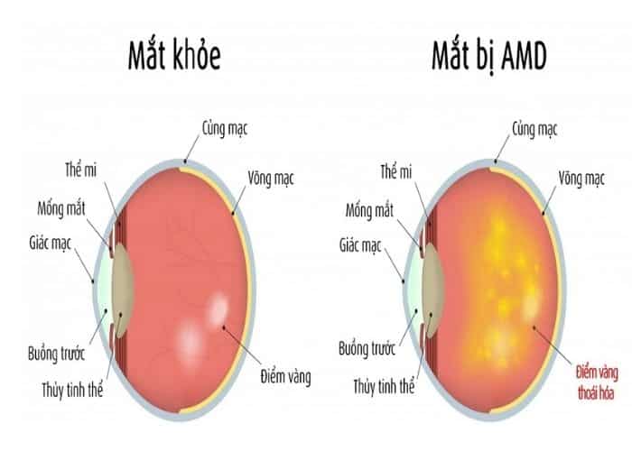 Thoái hoá hoàng điểm tuổi già 4