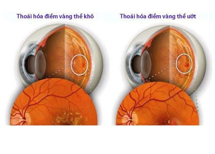 Thoái hoá hoàng điểm tuổi già 7