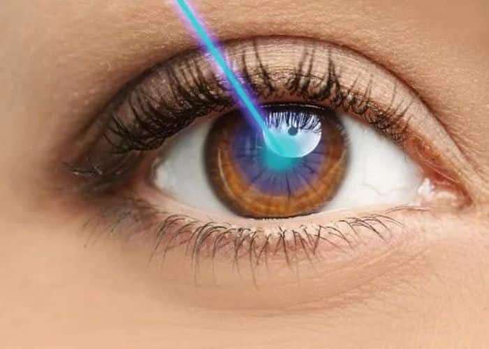 mổ cận Lasik dao OUP 5