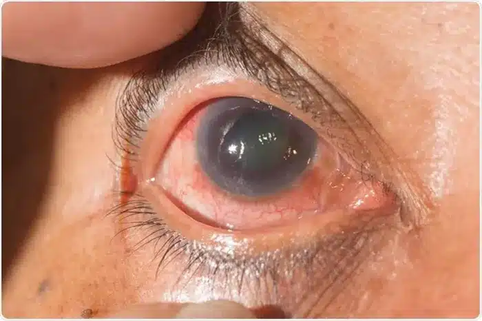 glaucoma không được điều trị sớm sẽ dẫn tới mù lòa