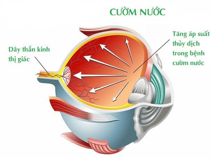 Thể thủy tinh 4