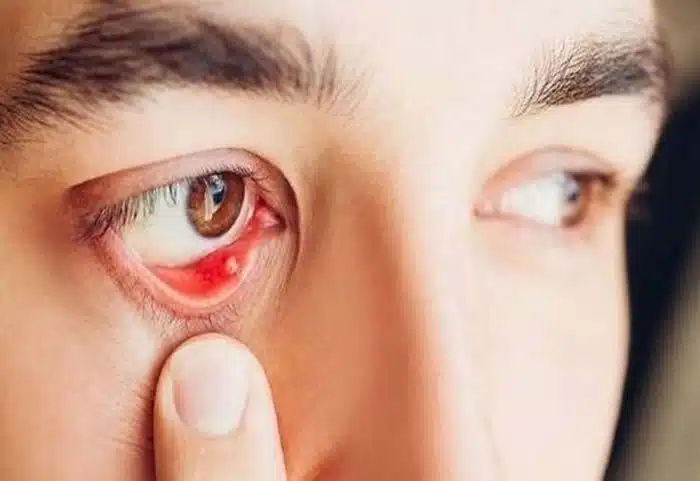 tiểu phẫu thủ thuật mắt 2