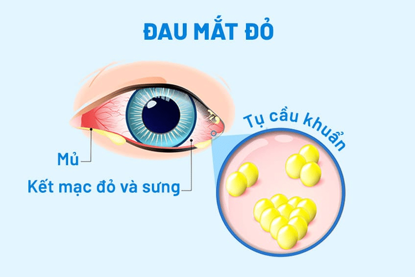 Tìm hiểu chi phí khám đau mắt đỏ tại bệnh viện Bình Tâm